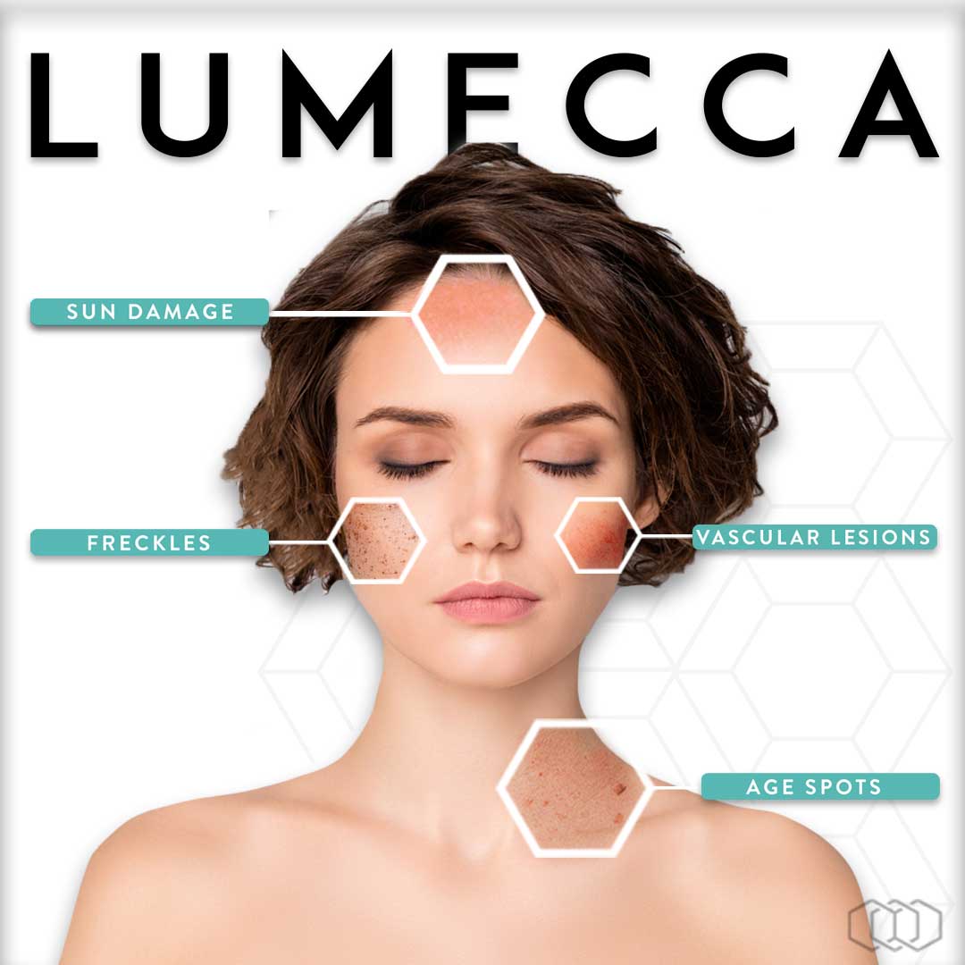 Lumecca IPL