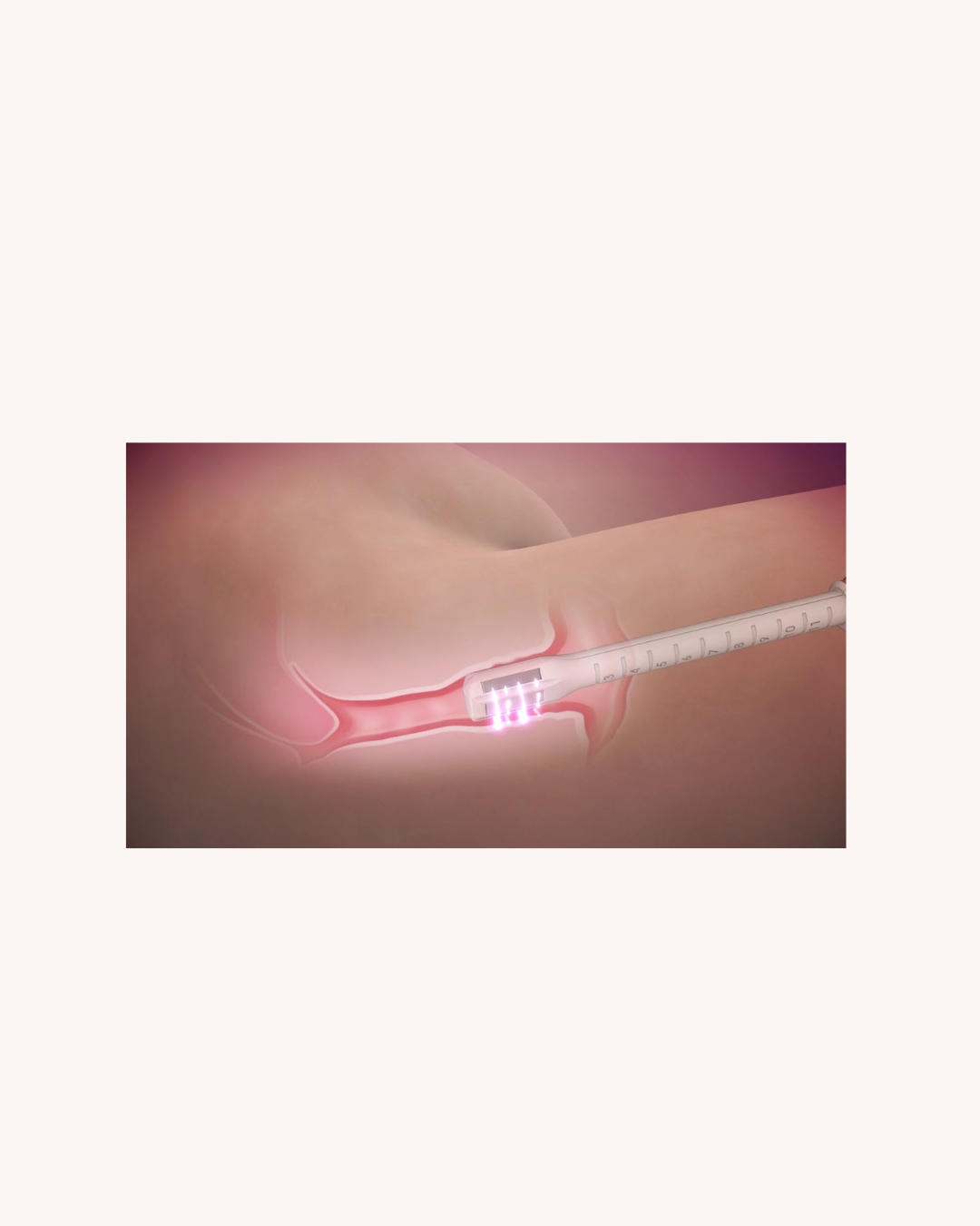 InMode Plus90 - Intimate Wellness