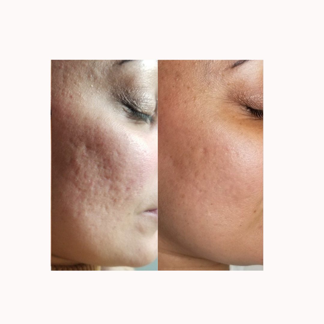 Subcision Skin Changes Subcision – From 1% Skin Lab