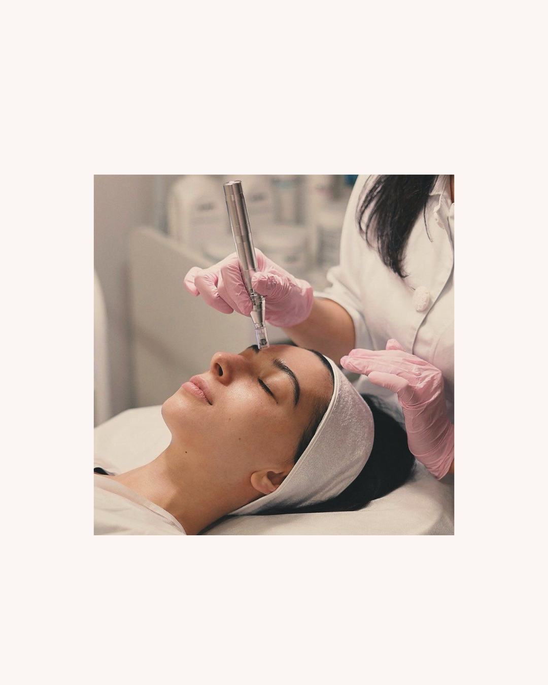 Microneedling