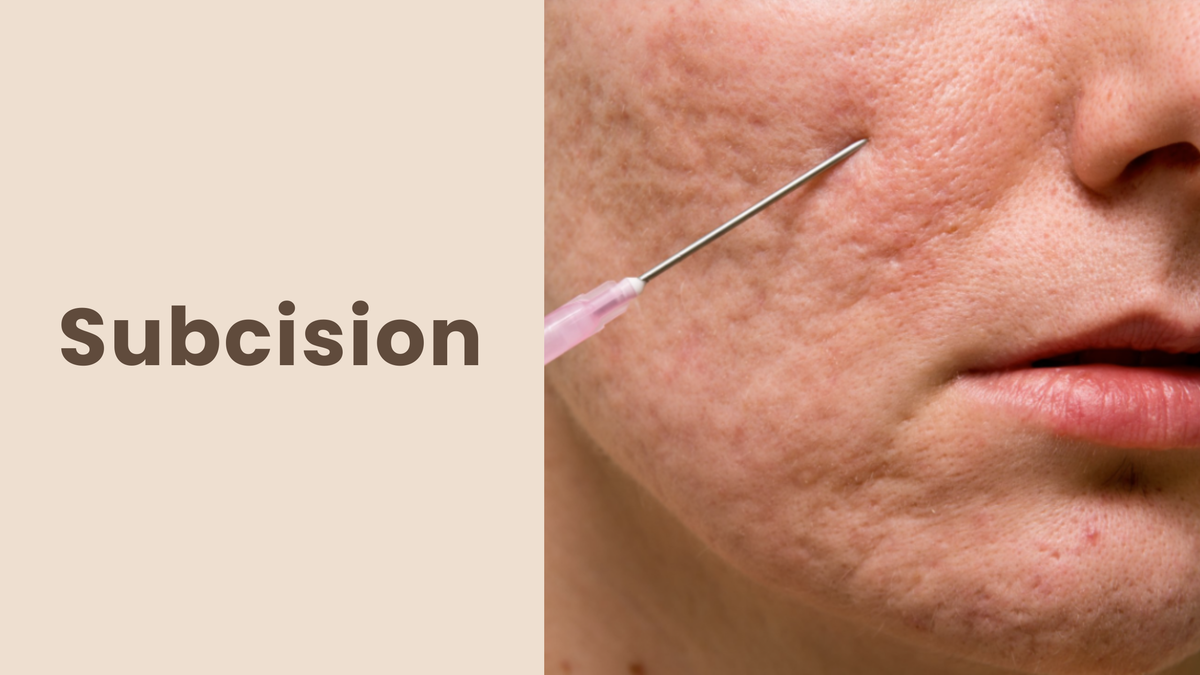 Subcision Skin Changes Subcision – From 1% Skin Lab