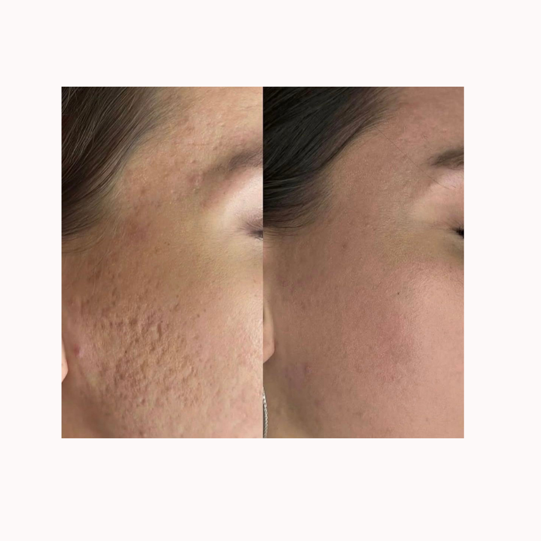 Subcision Skin Changes Subcision – From 1% Skin Lab