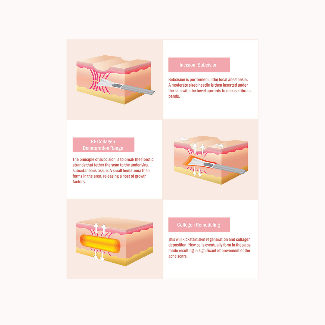 Subcision Skin Changes Subcision – From 1% Skin Lab