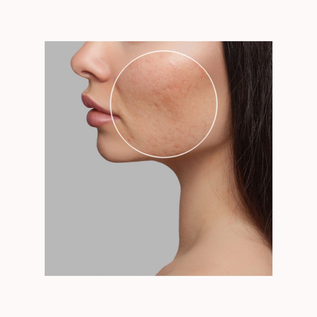 Subcision Skin Changes Subcision – From 1% Skin Lab