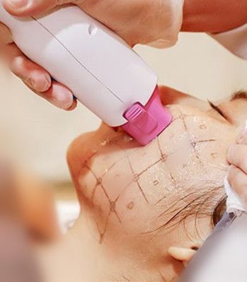 Thermage FLX Skin Tightening